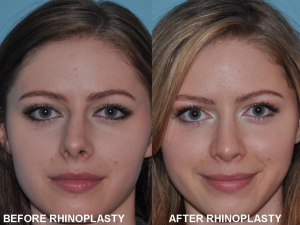 Rhinoplasty Before & After