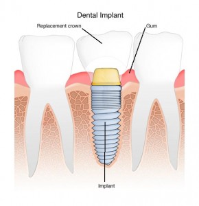 Villaggio Dental Implant