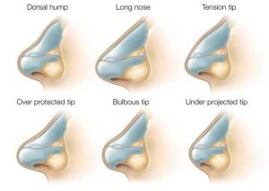 riynoplasty candidates