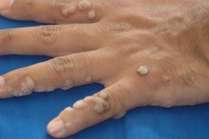 Warts before removal